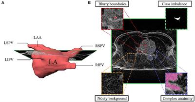 Mini Review: Deep Learning for Atrial Segmentation From Late Gadolinium-Enhanced MRIs